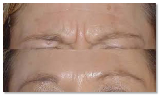 Botox Front